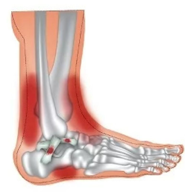 Muscle & Ligament Rehab Therapy stage2 | Global Health