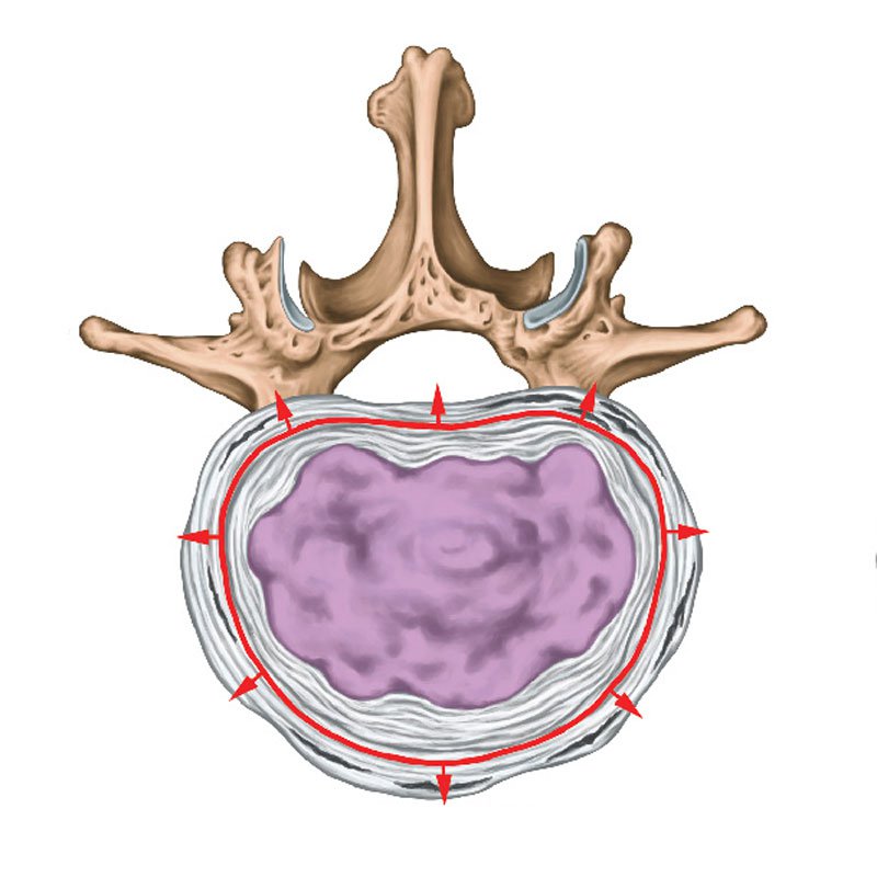 Slip Disc stage1 | Global Health