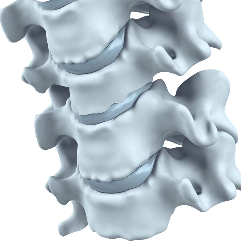 Ankylosing Spondylitis  stage2 | Global Health