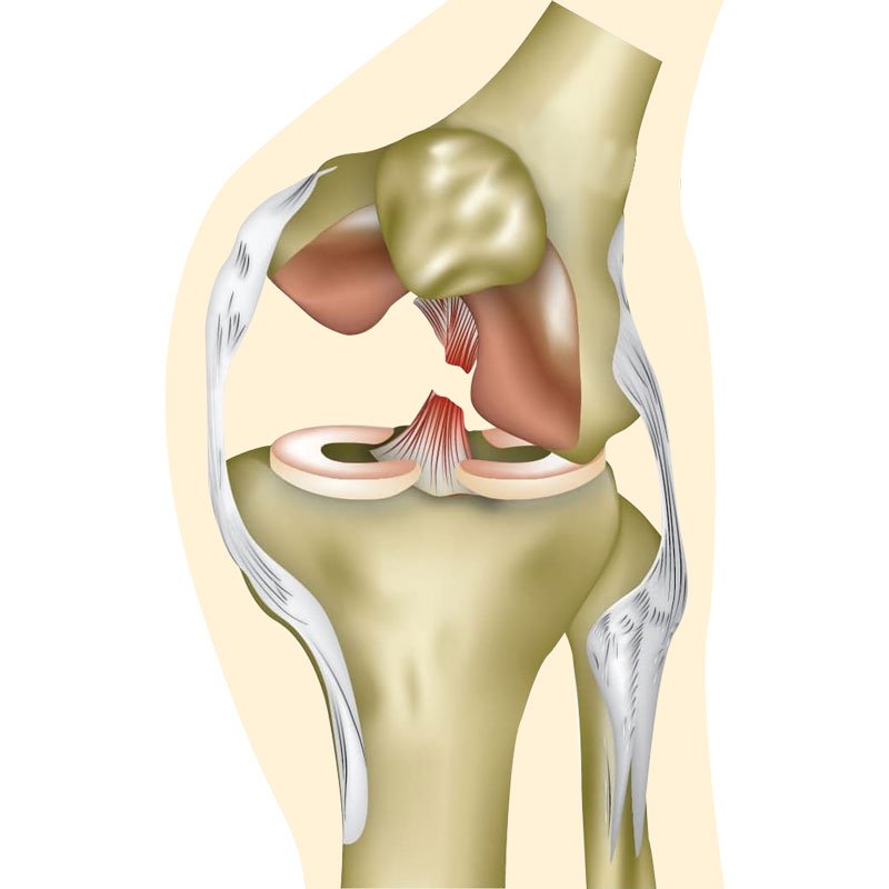 Acl Tear stage3 | Global Health