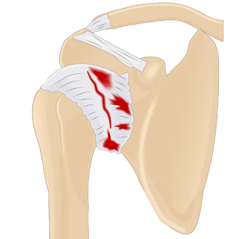 Frozen Shoulder stage2 | Global Health