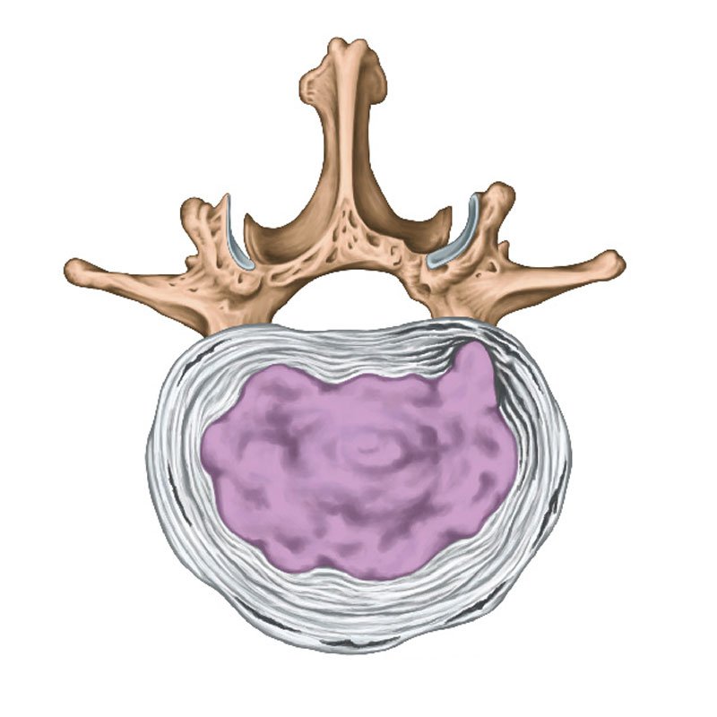 Slip Disc stage2 | Global Health