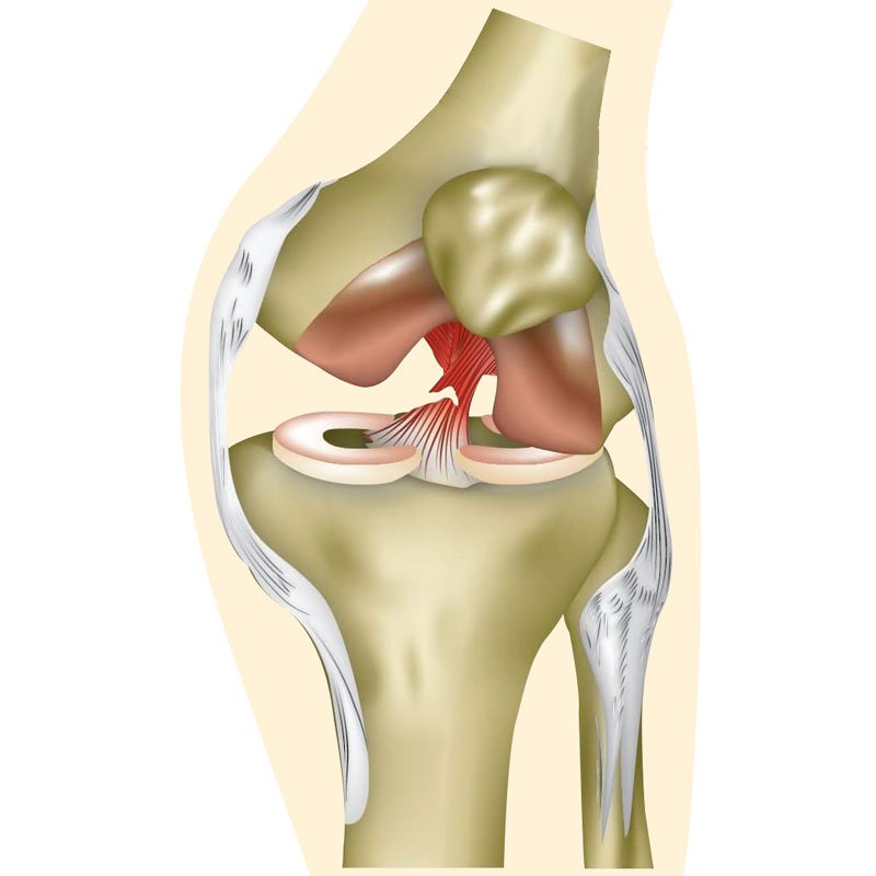 Acl Tear stage2 | Global Health