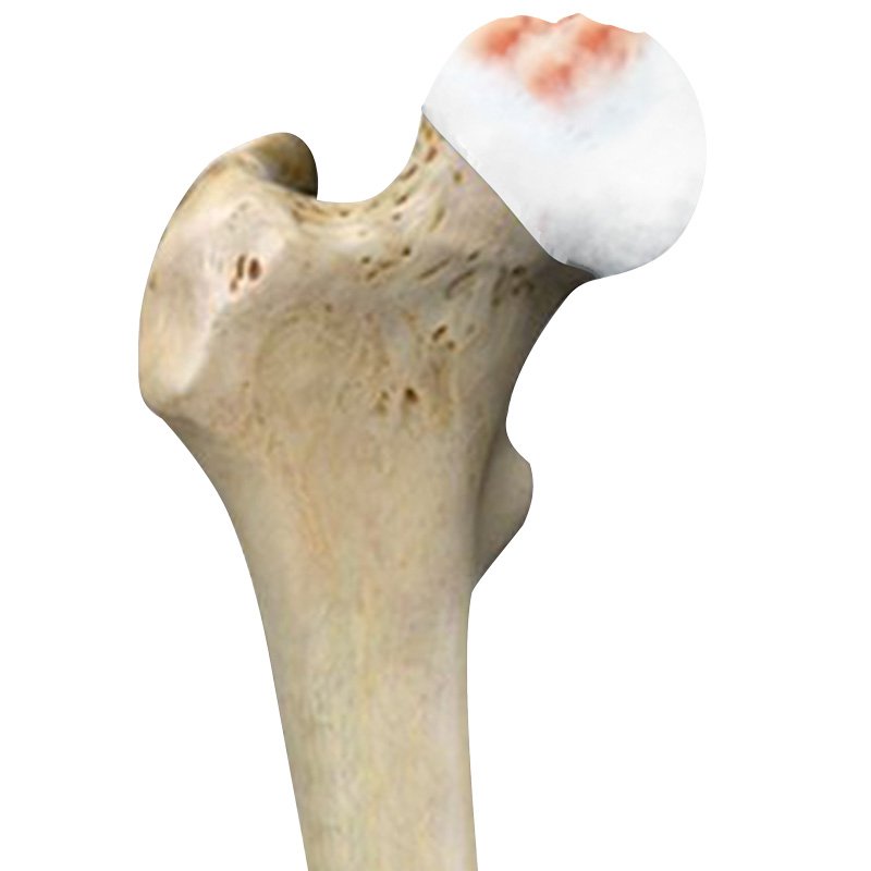 Avn Hip Joints stage2 | Global Health