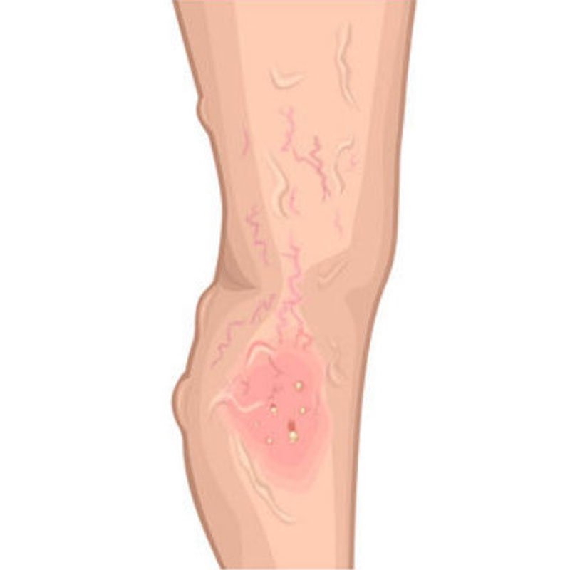 Venous Ulcer stage2 | Global Health