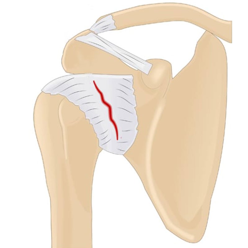 Frozen Shoulder stage1 | Global Health