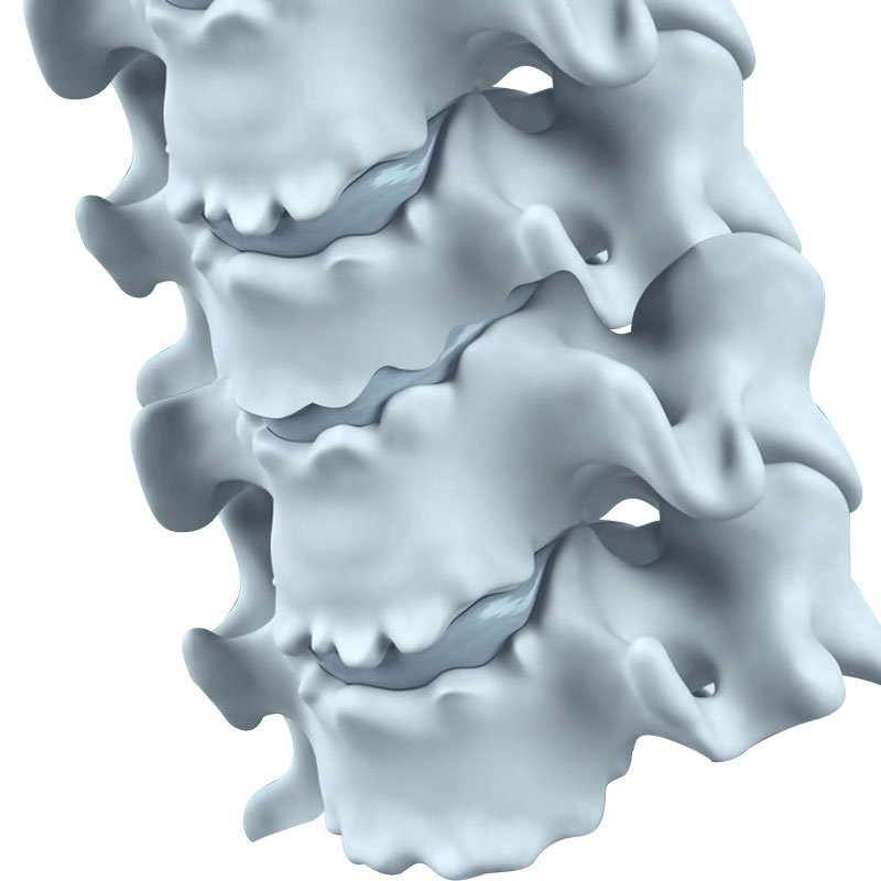 Cervical Spondylitis stage3 | Global Health