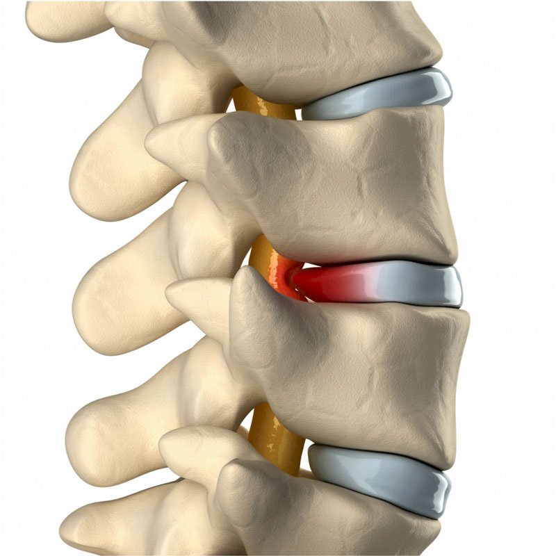 Sciatica Pain stage1 | Global Health