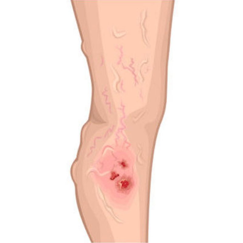 Venous Ulcer stage4 | Global Health