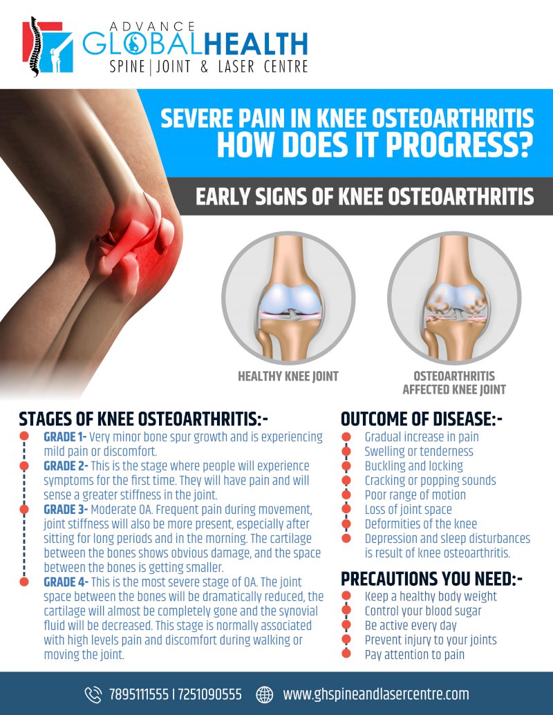 SEVERE PAIN IN KNEE OSTEOARTHRITIS, HOW DOES IT PROGRESS?