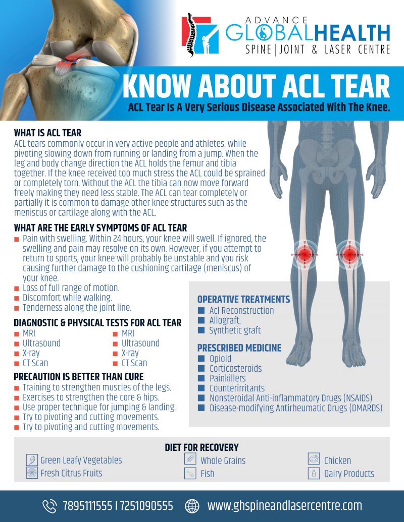 KNOW ABOUT ACL TEAR: ACL Tear Is A Very Serious Disease Associated With The Knee