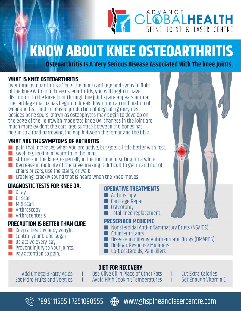 KNOW ABOUT KNEE OSTEOARTHRITIS Osteoarthritis Is A Very Serious Disease Associated With The knee Joints.