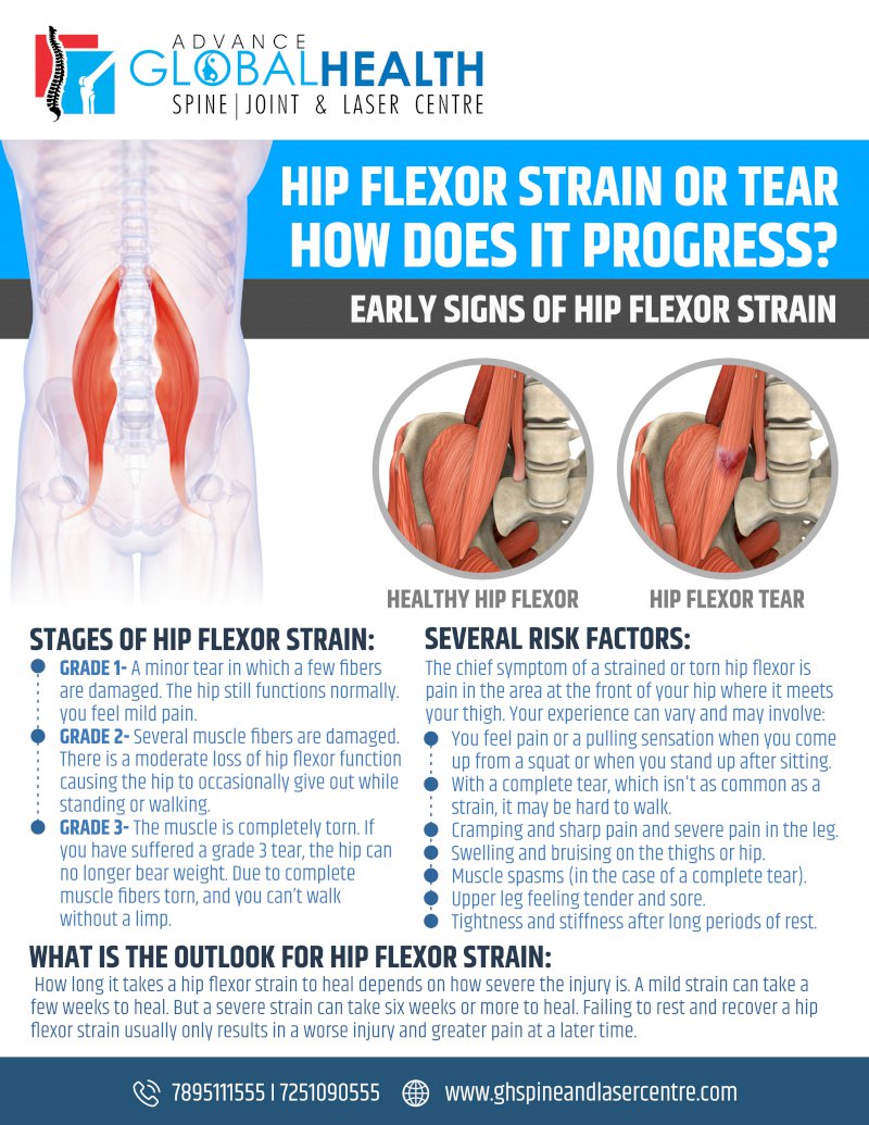 HIP FLEXOR STRAIN OR TEAR HOW DOES IT PROGRESS: EARLY SIGNS OF HIP FLEXOR STRAIN