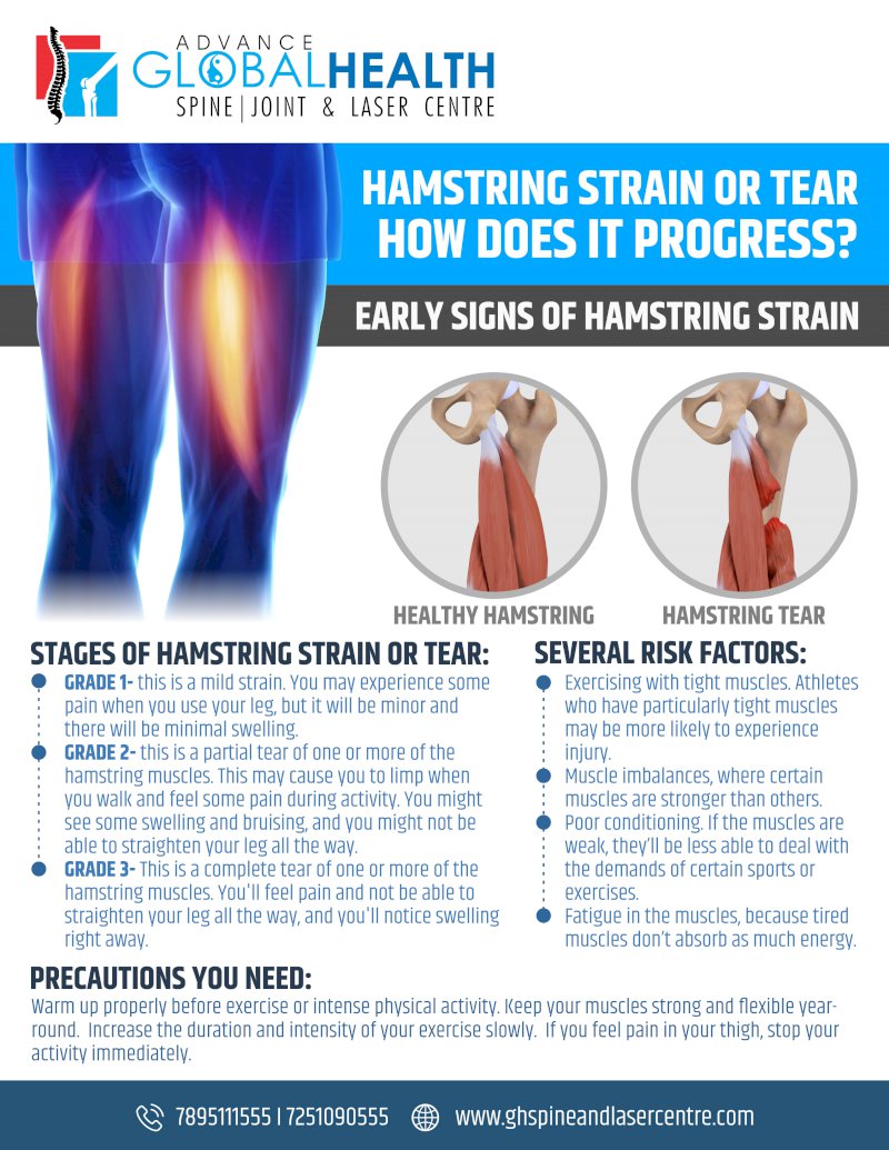 HAMSTRING STRAIN OR TEAR HOW DOES IT PROGRESS: EARLY SIGNS OF HAMSTRING STRAIN
