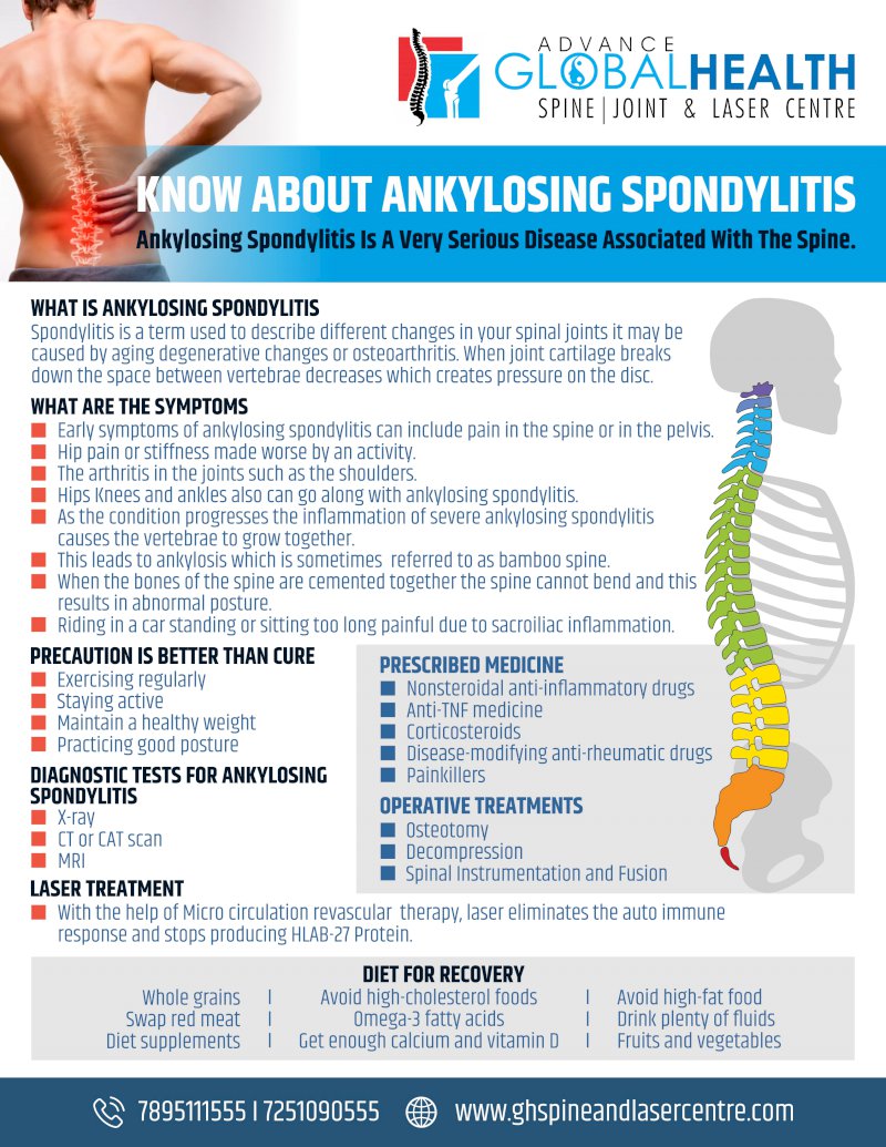 KNOW ABOUT ANKYLOSING SPONDYLITIS: Ankylosing Spondylitis Is A Very Serious Disease Associated With The Spine.