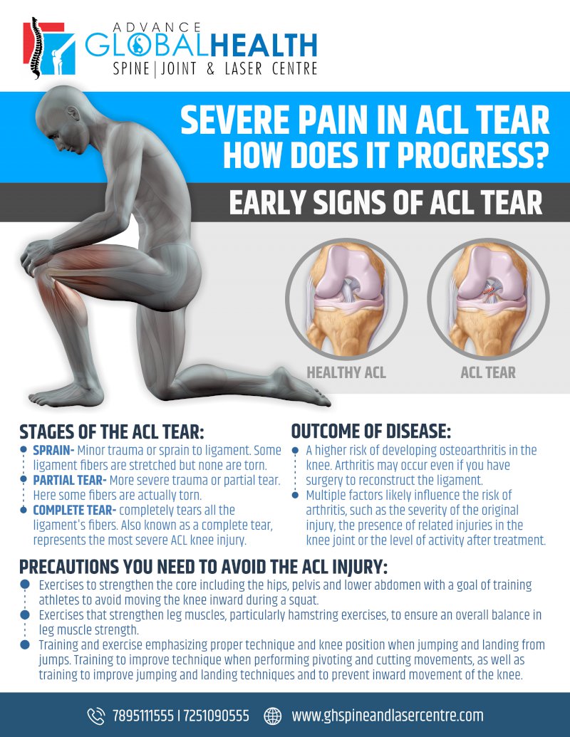 SEVERE PAIN IN ACL TEAR HOW DOES IT PROGRESS?