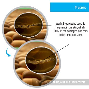 PROCESS | Global Health