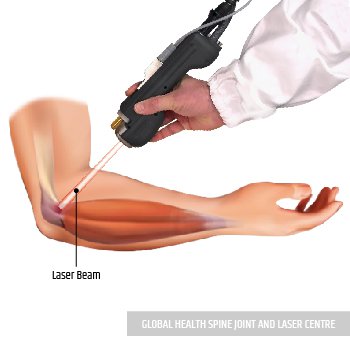 LASER TREATMENT | Global Health