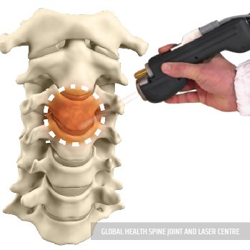 LASER TREATMENT | Global Health
