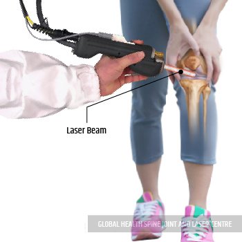 LASER TREATMENT  | Global Health