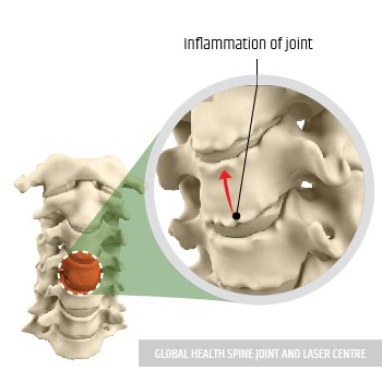 AFTER LASER TREATMENT | Global Health