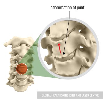 REDUCE THE INFLAMMATION | Global Health