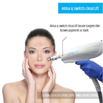 Alma q switch clearLift TREATMENT | Global Health