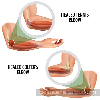 recovered tendon | Global Health