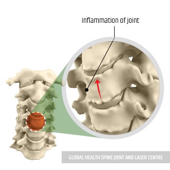 REDUCE THE INFLAMMATION | Global Health
