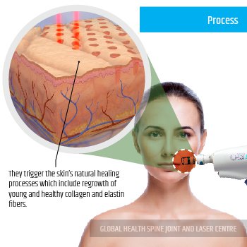 PROCESS | Global Health
