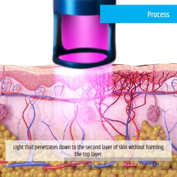 PROCESS | Global Health
