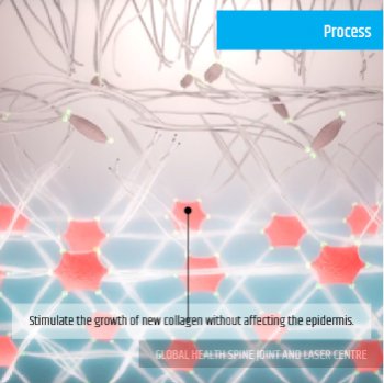 PROCESS | Global Health