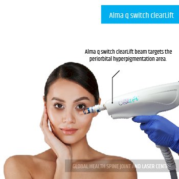  Alma q switch clearLift | Global Health