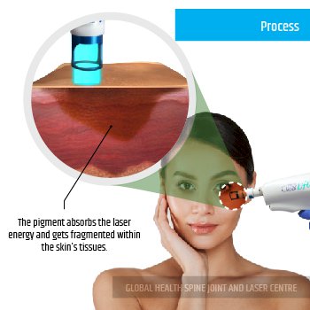 PROCESS | Global Health