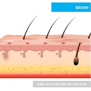 OUTCOME | Global Health