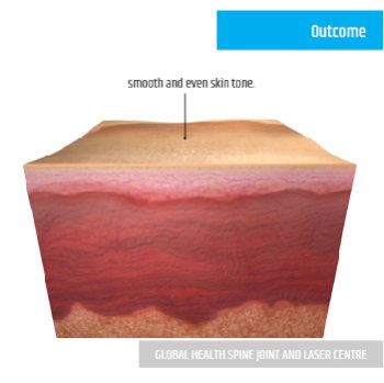 OUTCOME | Global Health