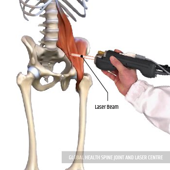 LASER TREATMENT | Global Health