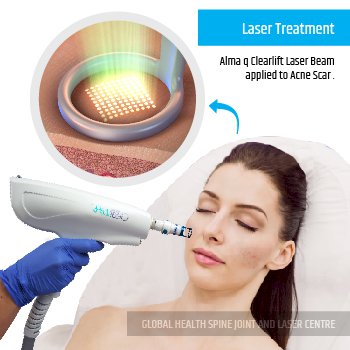 LASER TREATMENT | Global Health