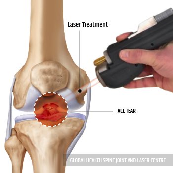 LASER TREATMENT | Global Health
