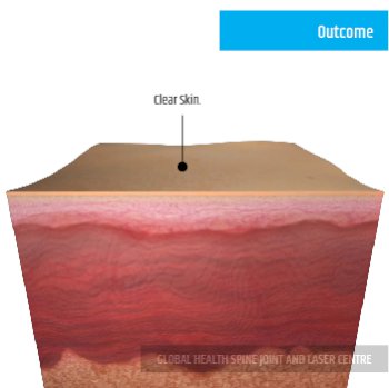 OUTCOME | Global Health