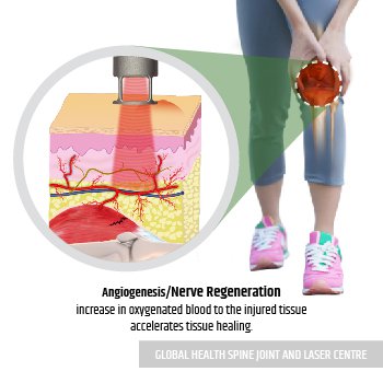 ANGIOGENESIS/ NERVE REGENERATION | Global Health