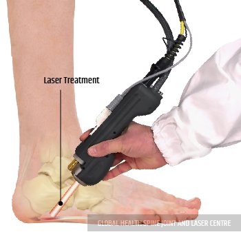 LASER TREATMENT | Global Health