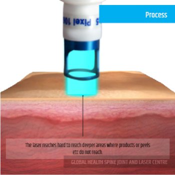 PROCESS | Global Health