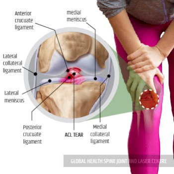 DIAGNOSIS  PARTIAL LIAGAMENT TEAR | Global Health