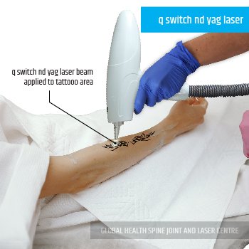 q switch nd yag laser | Global Health
