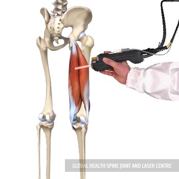 LASER TREATMENT | Global Health