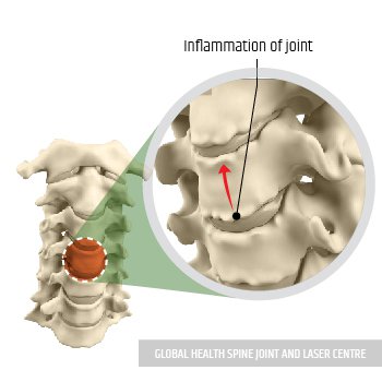 REDUCE THE INFLAMMATION | Global Health