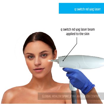 q switch nd yag laser | Global Health