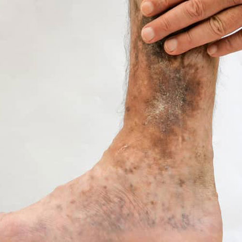 Venous Ulcer | Global Health