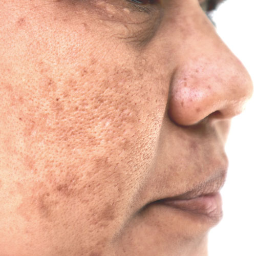 Pigmentations  | Global Health